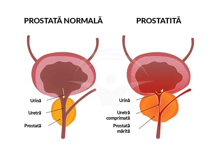 unde se tratează prostatita cronică medicamente hormonale pentru prostatita